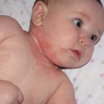 Khi trẻ nổi mẩn đỏ khắp người nhưng không sốt cần làm gì?