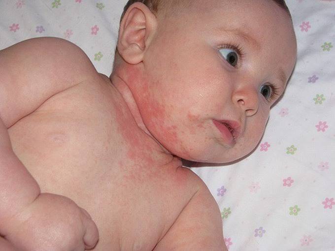 Khi trẻ nổi mẩn đỏ khắp người nhưng không sốt cần làm gì?